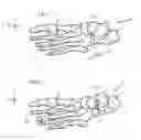 Fig. 02 - System and method for non-binding allograft subtalar joint implant