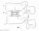 Fig. 02 - Expandable fusion device and method of installation thereof