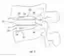 Fig. 10 - Expandable fusion device and method of installation thereof
