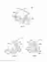 Fig. 25 - Expandable fusion device and method of installation thereof