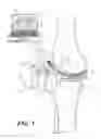 Fig. 02 - Surgical apparatus to support installation of a prosthetic component and method therefore
