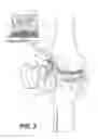 Fig. 03 - Surgical apparatus to support installation of a prosthetic component and method therefore