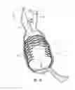 Fig. 08 - Obesity treatment devices, systems, and methods