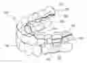 Fig. 01 - Multi-appliance system and method for treating obstructive sleep apnea and correcting malocclusion simultaneously
