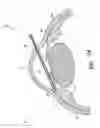 Fig. 63 - Controlled drug delivery ocular implants and methods of using same
