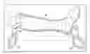 Fig. 01 - Total contact cast system and methods for safe and easy removal thereof