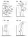 Fig. 37 - DEVICES ENABLING THE DISABLED TO STAND, WALK AND ACTIVATE ONE'S BODY