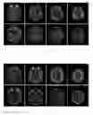 Fig. 07 - Joint application of statin and adrenocortical hormone for treating chronic subdural hematoma