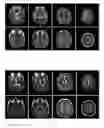 Fig. 08 - Joint application of statin and adrenocortical hormone for treating chronic subdural hematoma