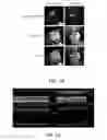 Fig. 12 - EVALUATION OF PRESENCE OF AND VULNERABILITY TO ATRIAL FIBRILLATION AND OTHER INDICATIONS USING MATRIX METALLOPROTEINASE-BASED IMAGING