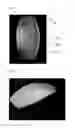 Fig. 02 - Sternum replacement implant