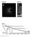 Fig. 04 - Light adjustable intraocular lenses using upconverting nanoparticles and near infrared (NIR) light