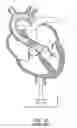 Fig. 16 - Catheter pump with positioning brace