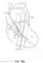 Fig. 20 - Catheter pump with positioning brace