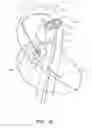 Fig. 23 - Catheter pump with positioning brace