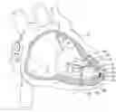 Fig. 01 - Leadless delivery catheter with conductive pathway