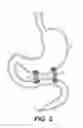 Fig. 06 - Medical device delivery system and methods of use