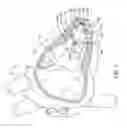 Fig. 02 - Delivery devices and methods for leadless cardiac devices