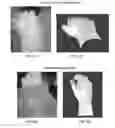 Fig. 08 - Systems for neural bridging of the nervous system