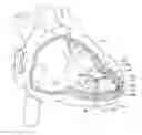 Fig. 01 - Fixation methods for leadless cardiac devices