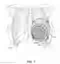 Fig. 06 - Radiation shielding implants and methods of use