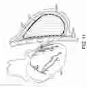 Fig. 10 - Radiation shielding implants and methods of use