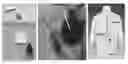 Fig. 01 - Device and method to treat esophageal disorders