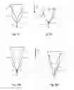 Fig. 07 - Device and method for separating a wishbone from a poultry carcass