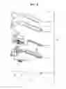Fig. 09 - Non-invasive method for measuring sound frequencies created by vortices in a carotid artery