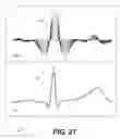 Fig. 22 - Automated ECG analysis and diagnosis system