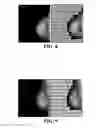Fig. 07 - Method and device for diagnosis of breast disease