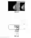 Fig. 09 - Method and device for diagnosis of breast disease