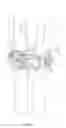 Fig. 03 - Device for carrying out a distraction for a compression of vertebral bodies during a spinal surgery
