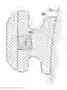 Fig. 01 - Orthodontic system with variably-sized archwire slot