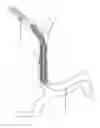 Fig. 197 - Thrombus aspiration facilitation systems