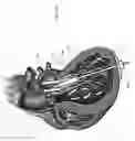Fig. 10 - Expandable device for capturing regurgitant jet, volume, and force to effect ventricular function and remodeling