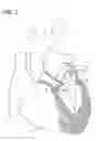 Fig. 02 - Lifetime regenerative heart valve