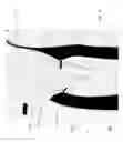 Fig. 11 - Inflatable device for improving physiological cardiac flow