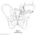 Fig. 02 - Methods of fusing a sacroiliac joint with an additively manufactured sacroiliac joint implant