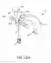 Fig. 147 - Methods of fusing a sacroiliac joint with an additively manufactured sacroiliac joint implant