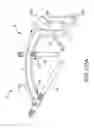 Fig. 149 - Methods of fusing a sacroiliac joint with an additively manufactured sacroiliac joint implant
