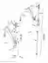 Fig. 20 - Methods of fusing a sacroiliac joint with an additively manufactured sacroiliac joint implant