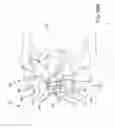 Fig. 55 - Methods of fusing a sacroiliac joint with an additively manufactured sacroiliac joint implant