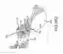 Fig. 64 - Methods of fusing a sacroiliac joint with an additively manufactured sacroiliac joint implant