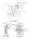 Fig. 70 - Methods of fusing a sacroiliac joint with an additively manufactured sacroiliac joint implant