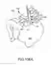 Fig. 74 - Methods of fusing a sacroiliac joint with an additively manufactured sacroiliac joint implant