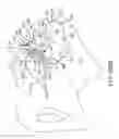 Fig. 75 - Methods of fusing a sacroiliac joint with an additively manufactured sacroiliac joint implant