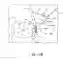 Fig. 77 - Methods of fusing a sacroiliac joint with an additively manufactured sacroiliac joint implant