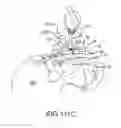 Fig. 82 - Methods of fusing a sacroiliac joint with an additively manufactured sacroiliac joint implant