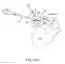 Fig. 84 - Methods of fusing a sacroiliac joint with an additively manufactured sacroiliac joint implant